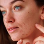 Master acne e pelle impura