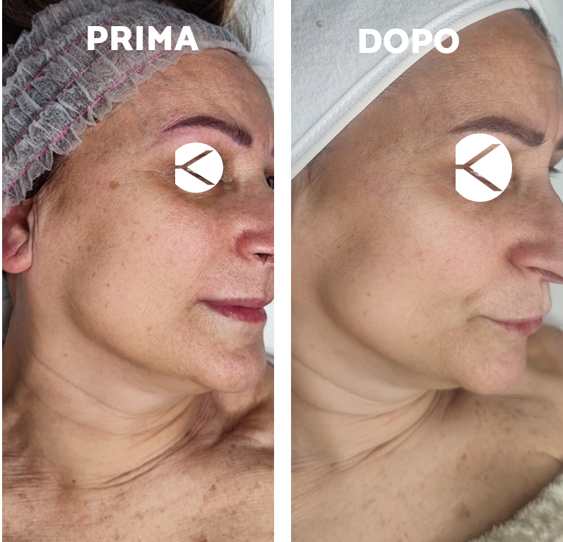 Prima e dopo - Iperpigmentazione