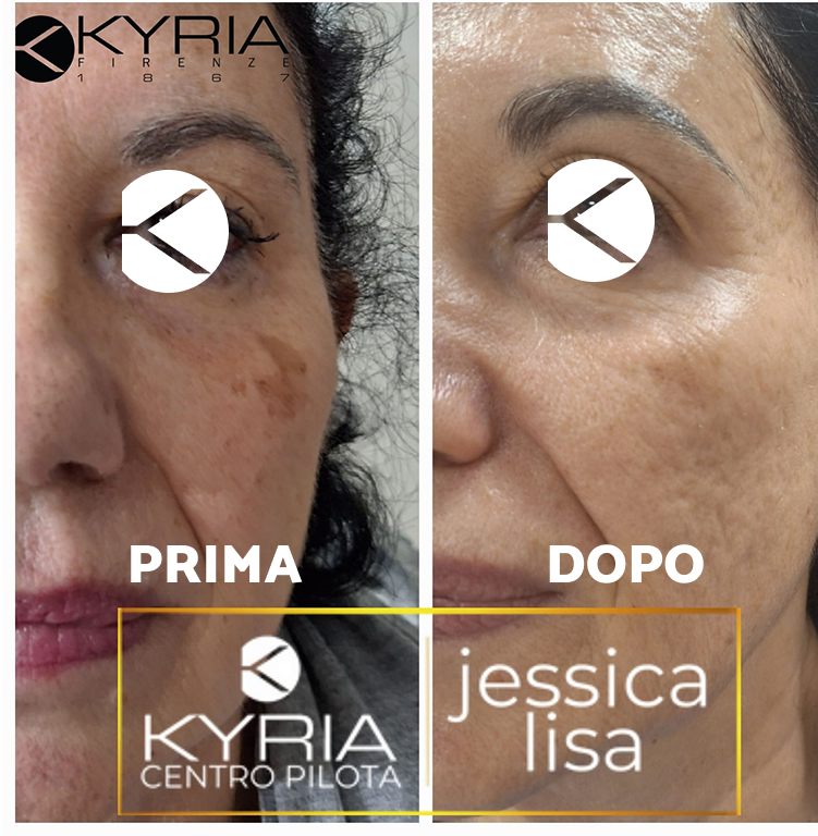 Prima e dopo - Contorni irregolari