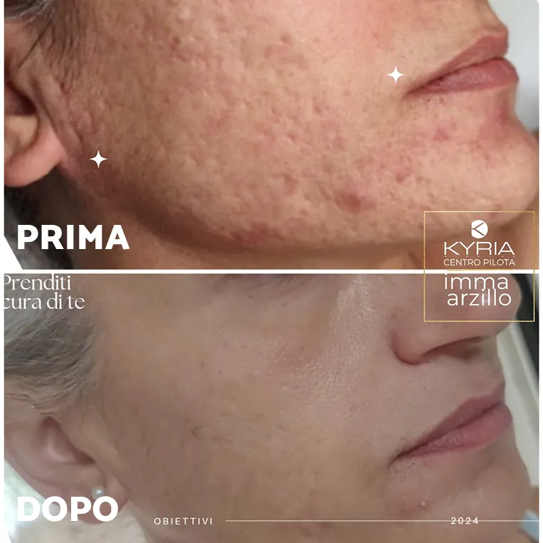 Prima e dopo Aqus-Derma