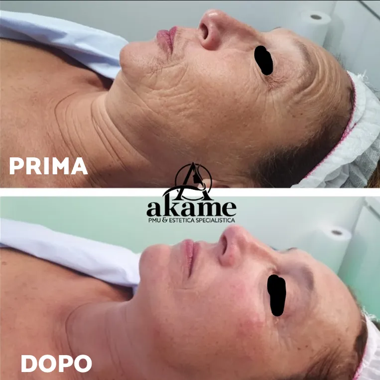 Prima e dopo Aqus-Derma