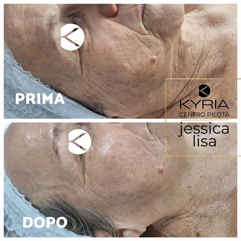 Prima e dopo Aqus-Derma